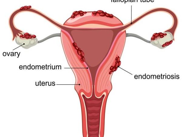 Understanding Endometriosis: What Causes It and Is It Your Fault?