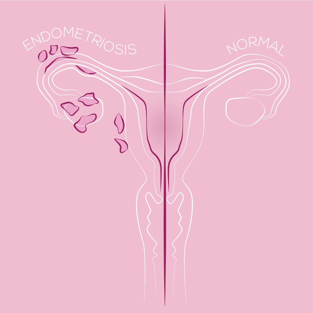endometriosis